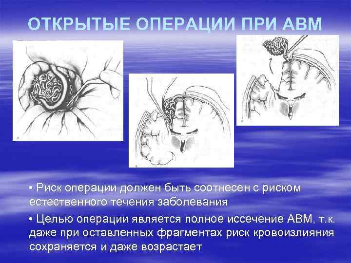 ОТКРЫТЫЕ ОПЕРАЦИИ ПРИ АВМ • Риск операции должен быть соотнесен с риском естественного течения