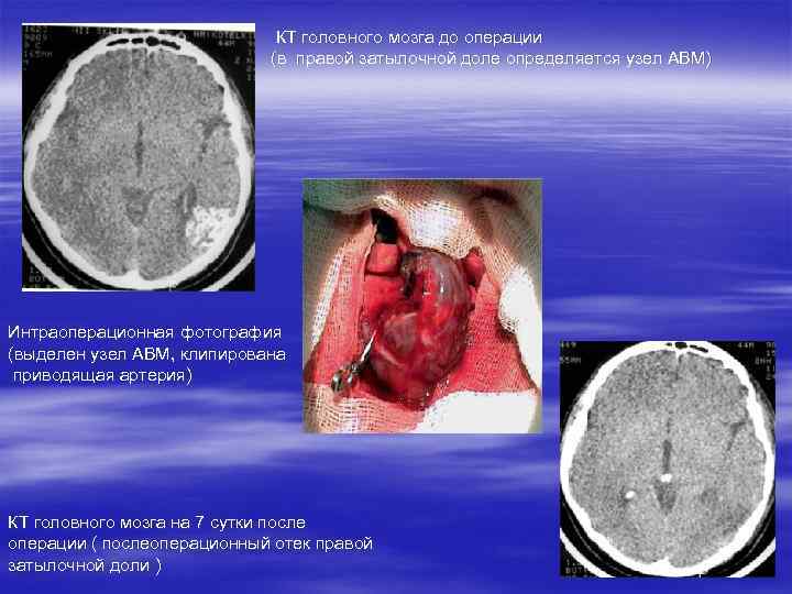 КТ головного мозга до операции (в правой затылочной доле определяется узел АВМ) Интраоперационная фотография