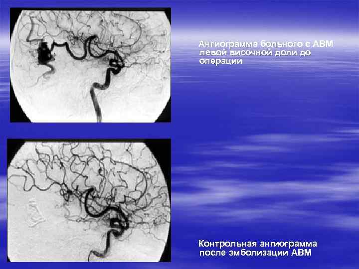  Ангиограмма больного с АВМ левой височной доли до операции Контрольная ангиограмма после эмболизации