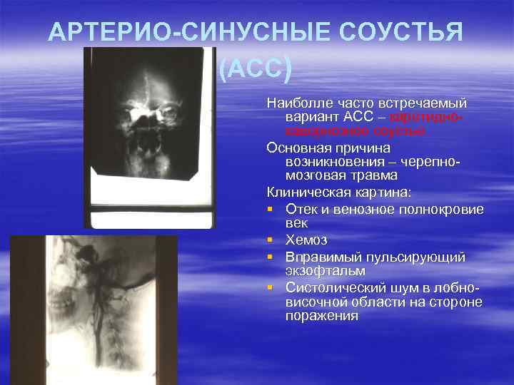 АРТЕРИО-СИНУСНЫЕ СОУСТЬЯ (АСС) Наиболле часто встречаемый вариант АСС – каротиднокавернозное соустье. Основная причина возникновения