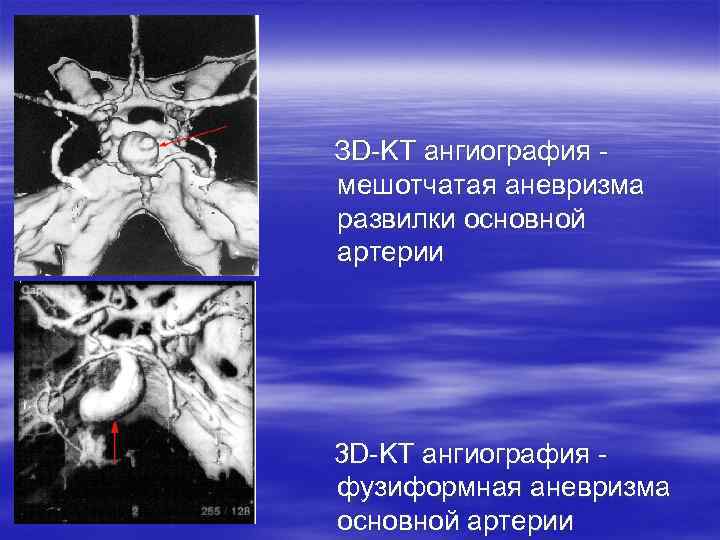 ЗD-KT ангиография мешотчатая аневризма развилки основной артерии 3 D-KT ангиография фузиформная аневризма основной артерии