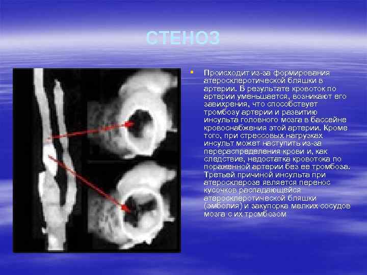 СТЕНОЗ § Происходит из-за формирования атеросклеротической бляшки в артерии. В результате кровоток по артерии
