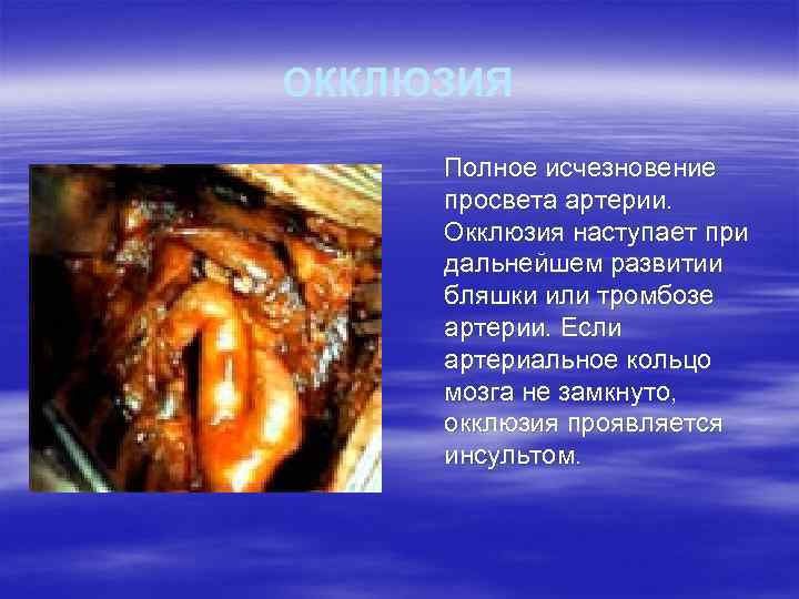 ОККЛЮЗИЯ Полное исчезновение просвета артерии. Окклюзия наступает при дальнейшем развитии бляшки или тромбозе артерии.