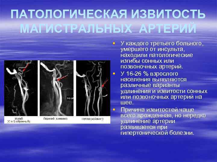 ПАТОЛОГИЧЕСКАЯ ИЗВИТОСТЬ МАГИСТРАЛЬНЫХ АРТЕРИЙ § У каждого третьего больного, умершего от инсульта, находили патологические