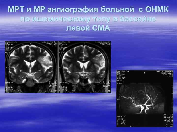 МРТ и МР ангиография больной с ОНМК по ишемическому типу в бассейне левой СМА