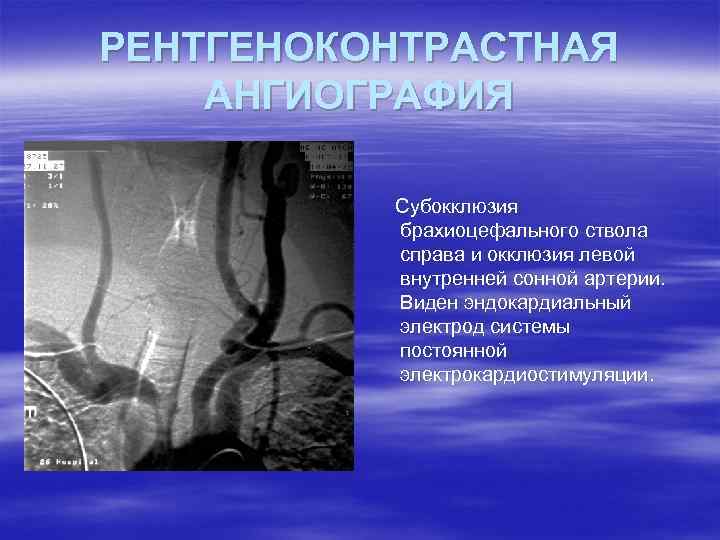 РЕНТГЕНОКОНТРАСТНАЯ АНГИОГРАФИЯ Субокклюзия брахиоцефального ствола справа и окклюзия левой внутренней сонной артерии. Виден эндокардиальный