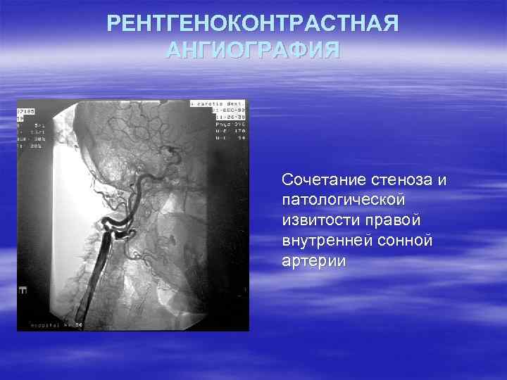 РЕНТГЕНОКОНТРАСТНАЯ АНГИОГРАФИЯ Сочетание стеноза и патологической извитости правой внутренней сонной артерии 