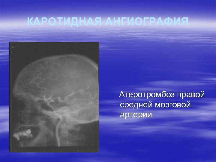 КАРОТИДНАЯ АНГИОГРАФИЯ Атеротромбоз правой средней мозговой артерии 