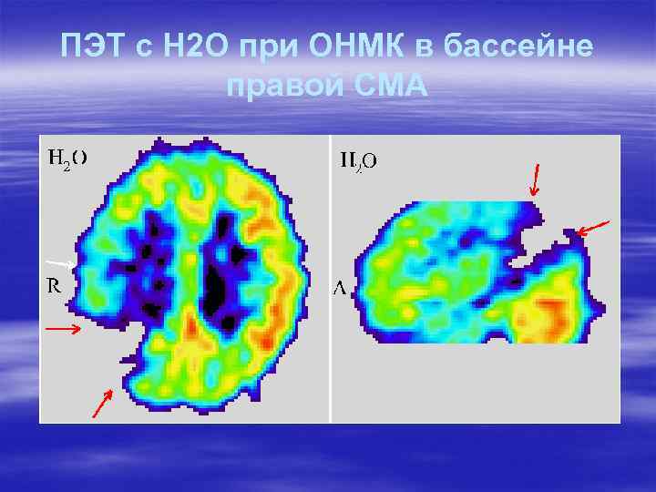 ПЭТ с H 2 O при ОНМК в бассейне правой СМА 