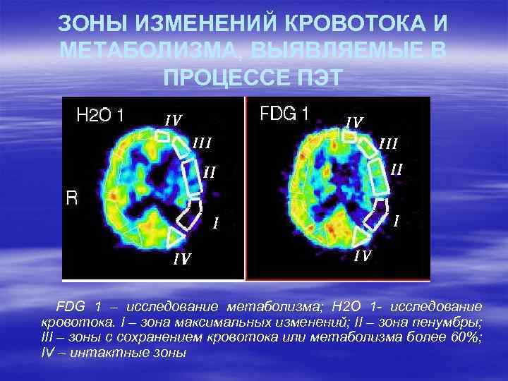 ЗОНЫ ИЗМЕНЕНИЙ КРОВОТОКА И МЕТАБОЛИЗМА, ВЫЯВЛЯЕМЫЕ В ПРОЦЕССЕ ПЭТ FDG 1 – исследование метаболизма;