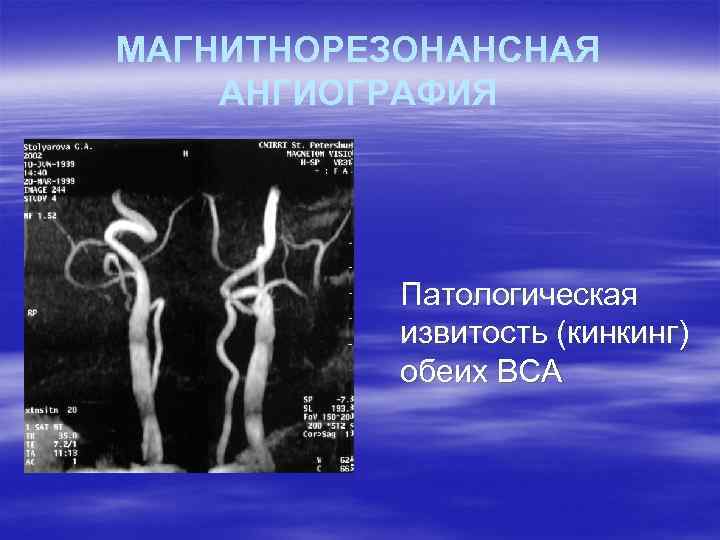 МАГНИТНОРЕЗОНАНСНАЯ АНГИОГРАФИЯ Патологическая извитость (кинкинг) обеих ВСА 
