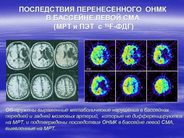 ПОСЛЕДСТВИЯ ПЕРЕНЕСЕННОГО ОНМК В БАССЕЙНЕ ЛЕВОЙ СМА (МРТ и ПЭТ с 18 F-ФДГ) Обнаружены