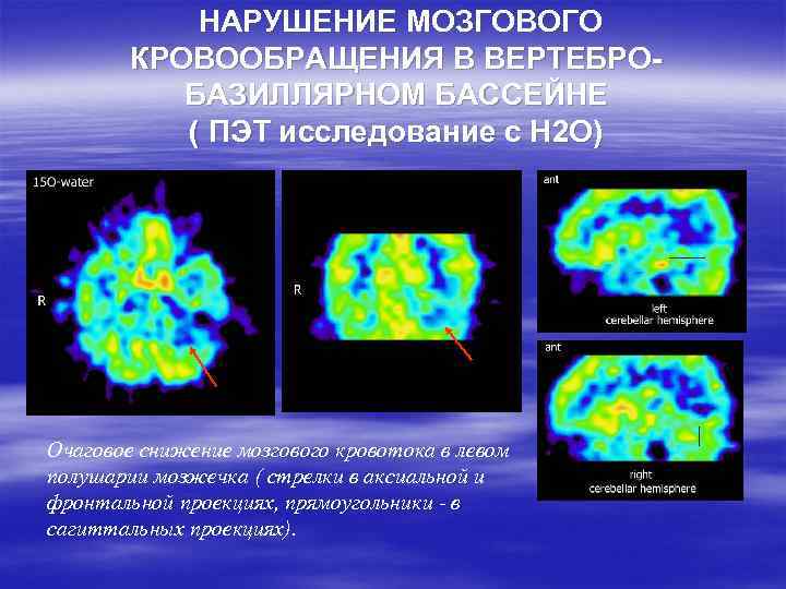 НАРУШЕНИЕ МОЗГОВОГО КРОВООБРАЩЕНИЯ В ВЕРТЕБРОБАЗИЛЛЯРНОМ БАССЕЙНЕ ( ПЭТ исследование с Н 2 О) Очаговое