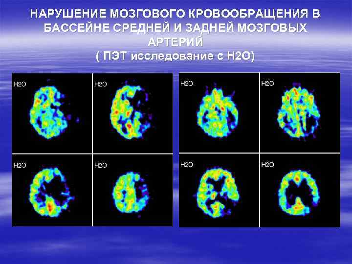 НАРУШЕНИЕ МОЗГОВОГО КРОВООБРАЩЕНИЯ В БАССЕЙНЕ СРЕДНЕЙ И ЗАДНЕЙ МОЗГОВЫХ АРТЕРИЙ ( ПЭТ исследование с