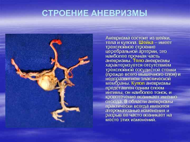 СТРОЕНИЕ АНЕВРИЗМЫ Аневризма состоит из шейки, тела и купола. Шейка – имеет трехслойное строение
