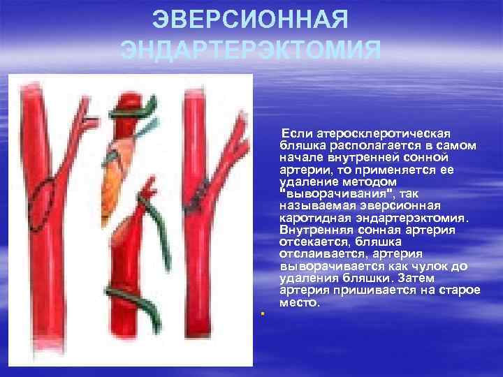 ЭВЕРСИОННАЯ ЭНДАРТЕРЭКТОМИЯ Если атеросклеротическая бляшка располагается в самом начале внутренней сонной артерии, то применяется