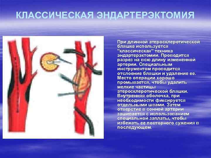 КЛАССИЧЕСКАЯ ЭНДАРТЕРЭКТОМИЯ При длинной атеросклеротической бляшке используется "классическая" техника эндартерэктомии. Проводится разрез на всю