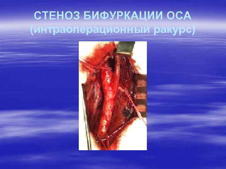 СТЕНОЗ БИФУРКАЦИИ ОСА (интраоперационный ракурс) 