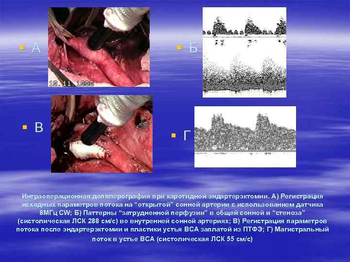 § А § В § Б § Г Интраоперационная допплерография при каротидной эндартерэктомии. А)
