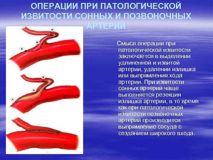 ОПЕРАЦИИ ПРИ ПАТОЛОГИЧЕСКОЙ ИЗВИТОСТИ СОННЫХ И ПОЗВОНОЧНЫХ АРТЕРИЙ Смысл операции при патологической извитости заключается
