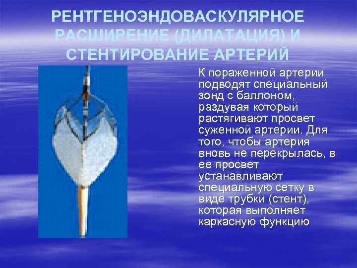 РЕНТГЕНОЭНДОВАСКУЛЯРНОЕ РАСШИРЕНИЕ (ДИЛАТАЦИЯ) И СТЕНТИРОВАНИЕ АРТЕРИЙ К пораженной артерии подводят специальный зонд с баллоном,