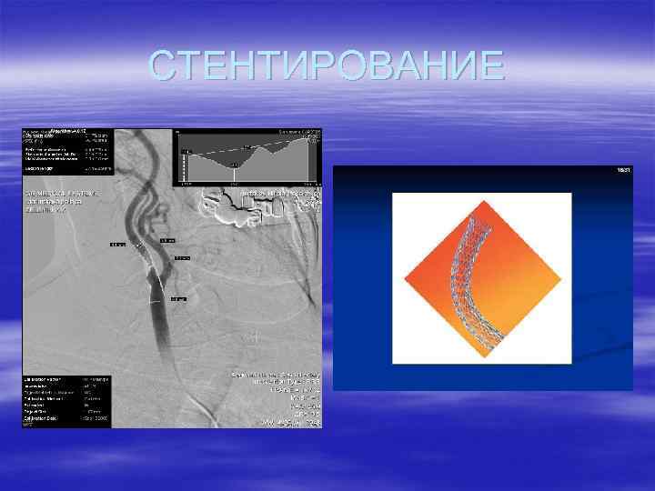 СТЕНТИРОВАНИЕ 