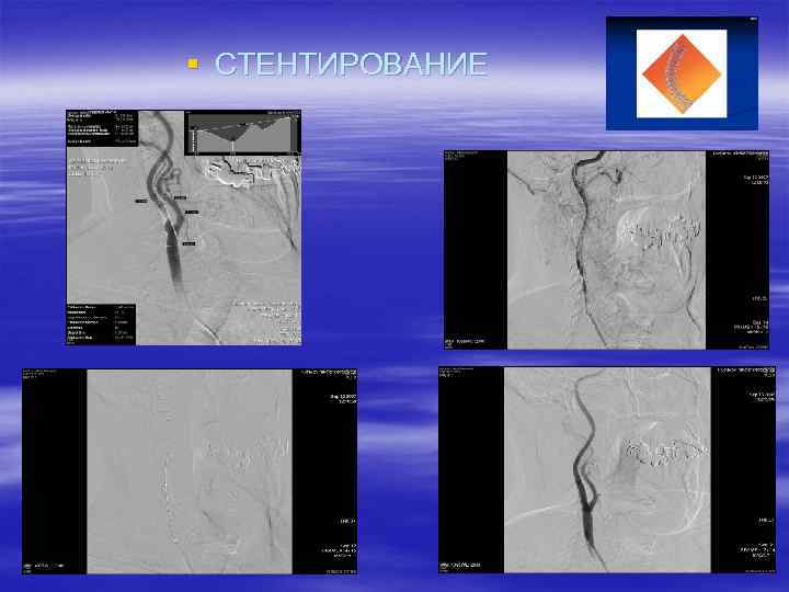§ СТЕНТИРОВАНИЕ 
