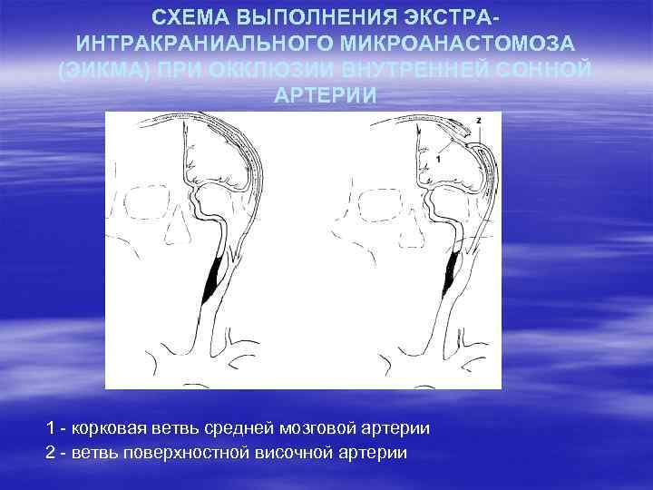 СХЕМА ВЫПОЛНЕНИЯ ЭКСТРАИНТРАКРАНИАЛЬНОГО МИКРОАНАСТОМОЗА (ЭИКМА) ПРИ ОККЛЮЗИИ ВНУТРЕННЕЙ СОННОЙ АРТЕРИИ 1 - корковая ветвь