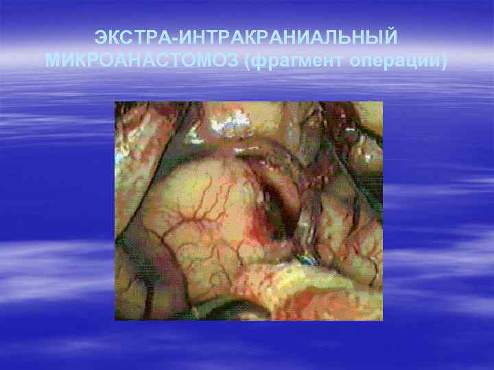 ЭКСТРА-ИНТРАКРАНИАЛЬНЫЙ МИКРОАНАСТОМОЗ (фрагмент операции) 