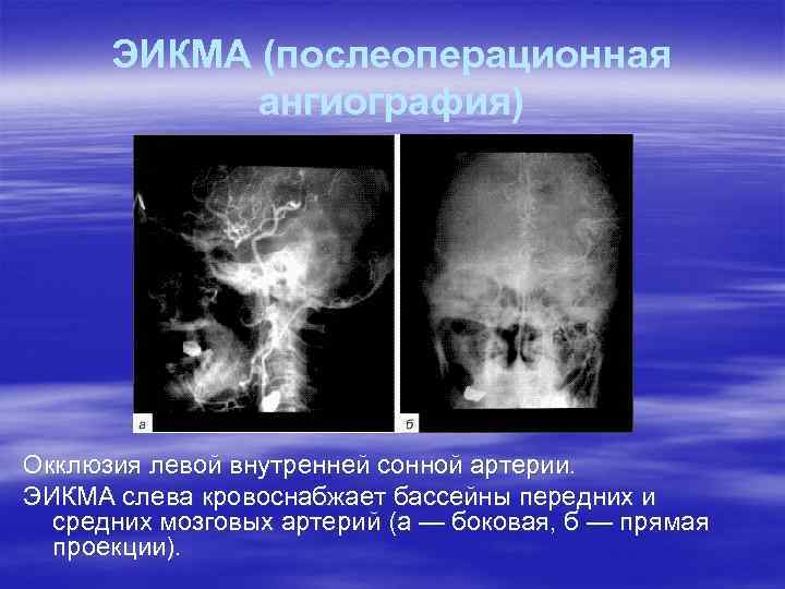 ЭИКМА (послеоперационная ангиография) Окклюзия левой внутренней сонной артерии. ЭИКМА слева кровоснабжает бассейны передних и