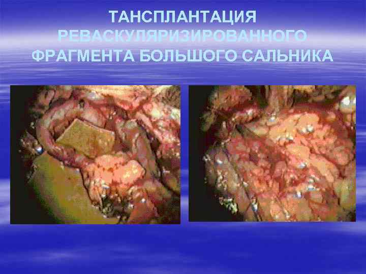 ТАНСПЛАНТАЦИЯ РЕВАСКУЛЯРИЗИРОВАННОГО ФРАГМЕНТА БОЛЬШОГО САЛЬНИКА 