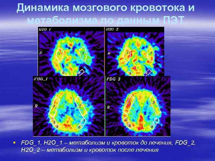 Динамика мозгового кровотока и метаболизма по данным ПЭТ § FDG_1, H 2 O_1 –