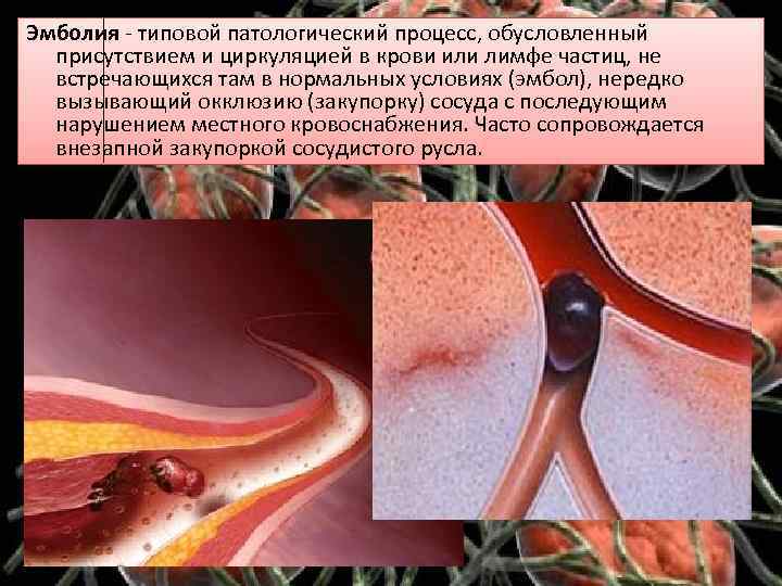 Эмболия - типовой патологический процесс, обусловленный присутствием и циркуляцией в крови или лимфе частиц,