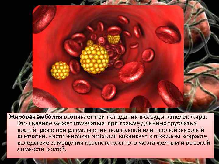 Жировая эмболия возникает при попадании в сосуды капелек жира. Это явление может отмечаться при