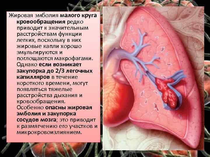 Жировая эмболия малого круга кровообращения редко приводит к значительным расстройствам функции легких, поскольку в