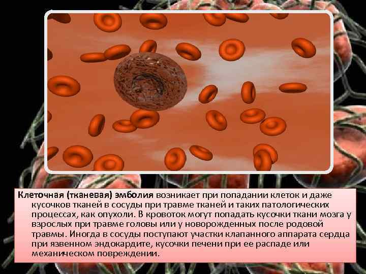 Клеточная (тканевая) эмболия возникает при попадании клеток и даже кусочков тканей в сосуды при