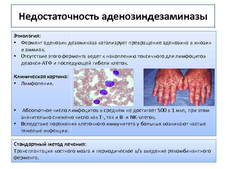 Недостаточность аденозиндезаминазы Этиология: • Фермент аденозин дезаминаза катализрует превращение аденозина в инозин и аммиак.