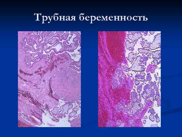 Трубная беременность 