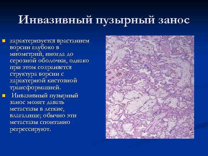 Пузырный занос. Пузырный занос патологическая анатомия. Инвазивный деструирующий пузырный занос. Пузырный занос гистология. Пузырный занос препарат патанатомия.