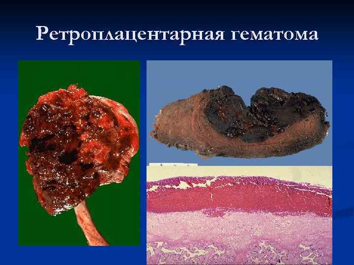 Ретроплацентарная гематома 