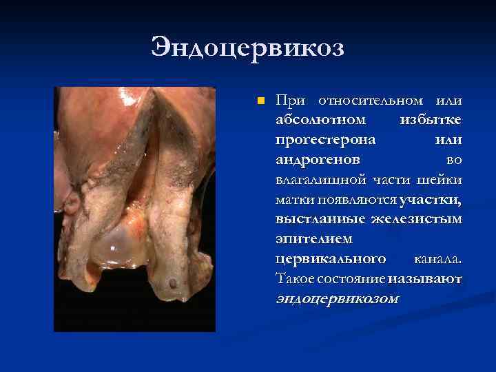 Эндоцервикоз n При относительном или абсолютном избытке прогестерона или андрогенов во влагалищной части шейки