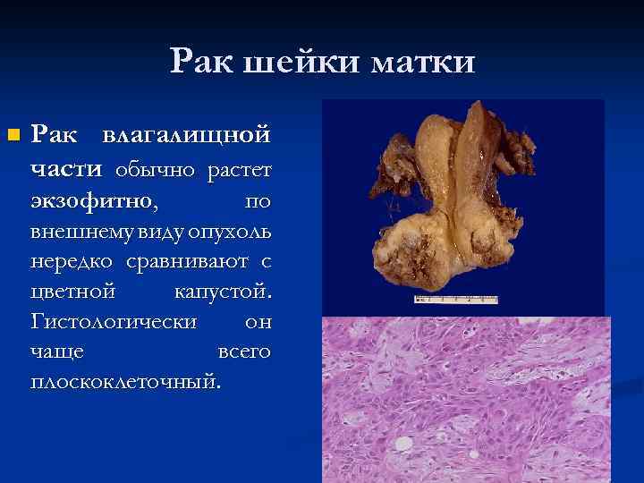 Рак шейки матки n Рак влагалищной части обычно растет экзофитно, по внешнему виду опухоль