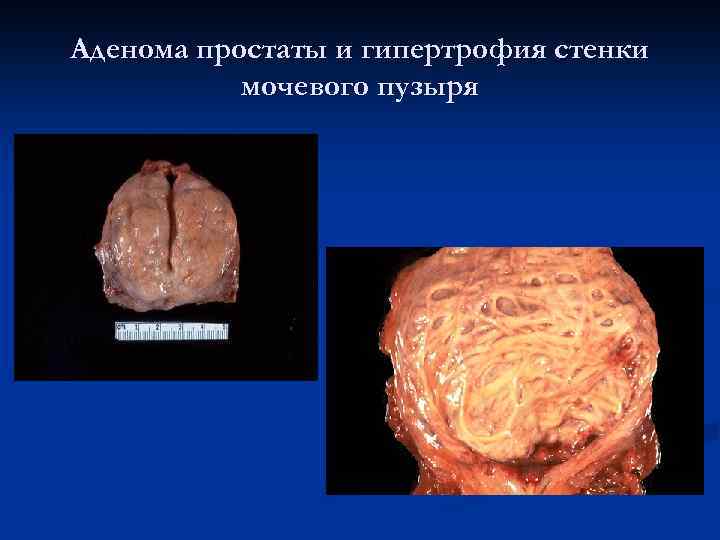 Аденома простаты и гипертрофия стенки мочевого пузыря 