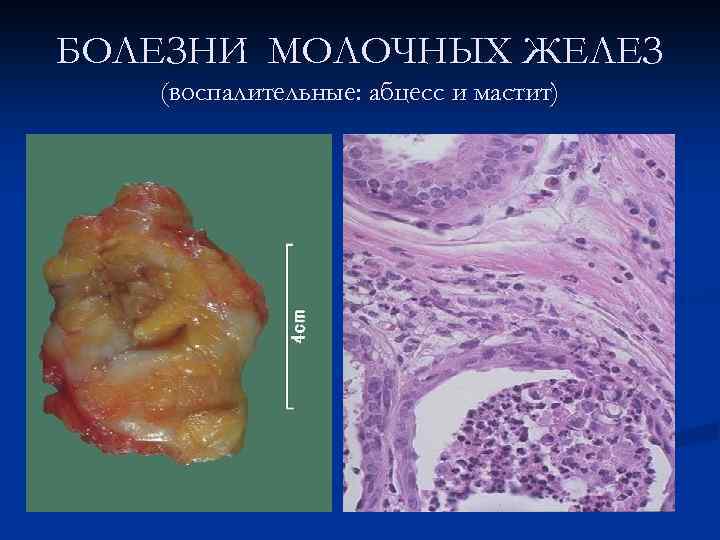 БОЛЕЗНИ МОЛОЧНЫХ ЖЕЛЕЗ (воспалительные: абцесс и мастит) 