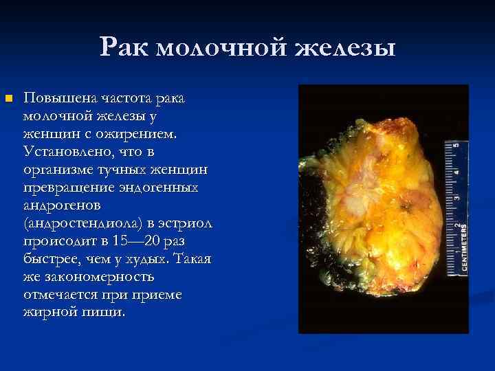 Рак молочной железы n Повышена частота рака молочной железы у женщин с ожирением. Установлено,