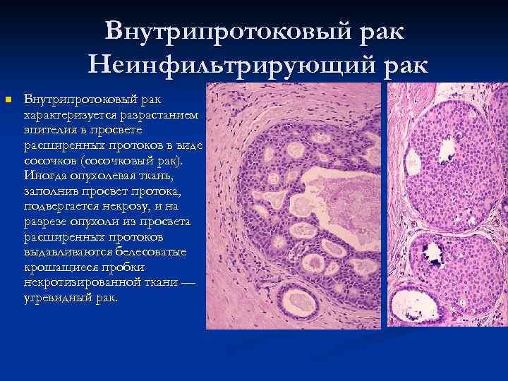 Внутрипротоковый рак Неинфильтрирующий рак n Внутрипротоковый рак характеризуется разрастанием эпителия в просвете расширенных протоков