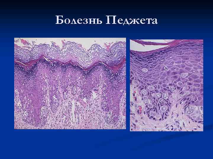 Рак молочной железы патанатомия