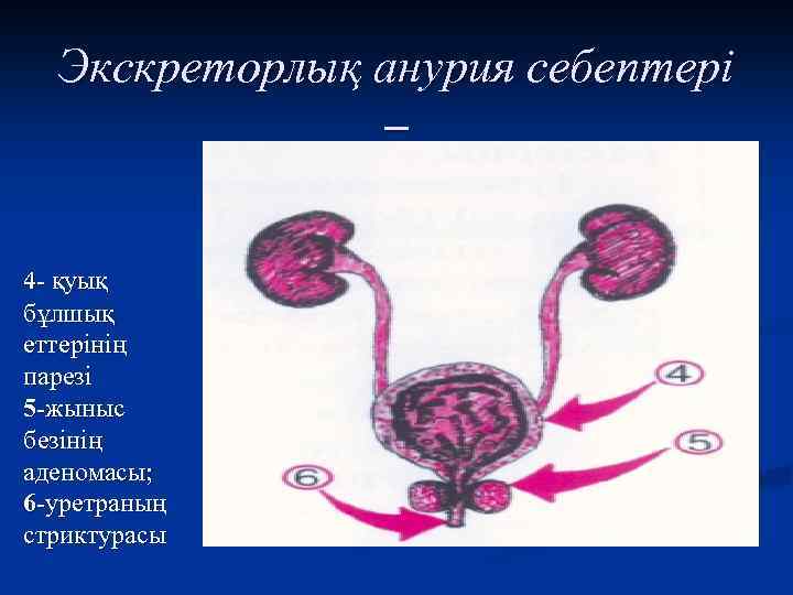Экскреторлық анурия себептері – 4 - қуық бұлшық еттерінің парезі 5 -жыныс безінің аденомасы;