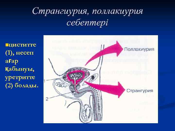 Странгиурия, поллакиурия себептері nциститте (1), несеп ағар қабынуы, уретритте (2) болады. 