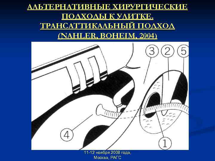 АЛЬТЕРНАТИВНЫЕ ХИРУРГИЧЕСКИЕ ПОДХОДЫ К УЛИТКЕ. ТРАНСАТТИКАЛЬНЫЙ ПОДХОД (NAHLER, BOHEIM, 2004) 11 -12 ноября 2008